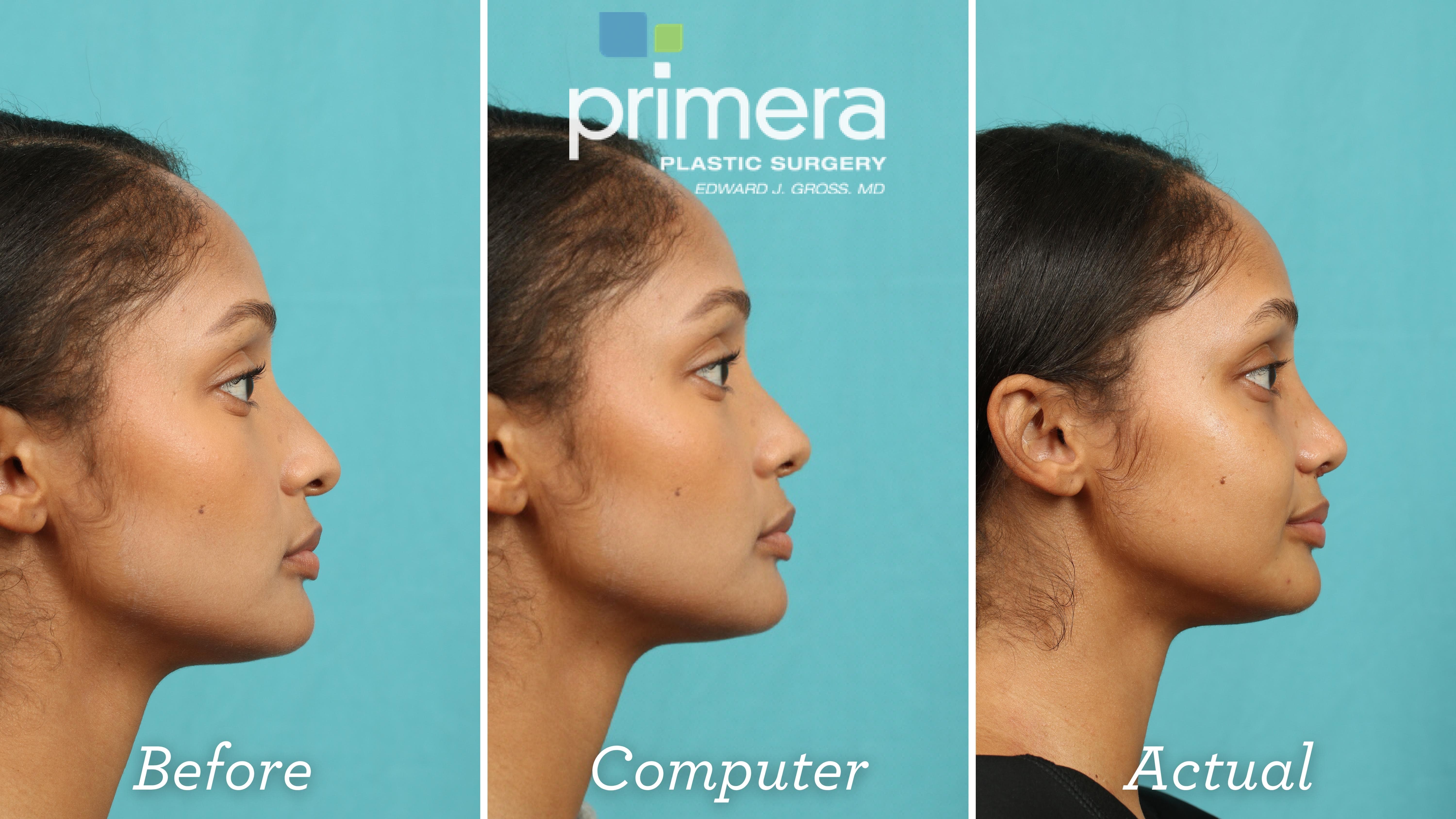 What Would I Look Like With a Nose Job? Predicting Your Rhinoplasty Results  in Orlando | Primera Plastic Surgery