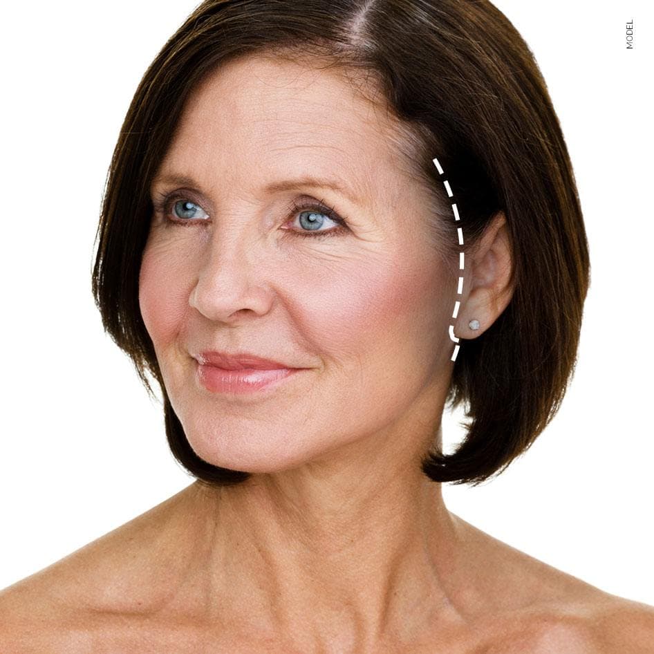 Facelift Incisions