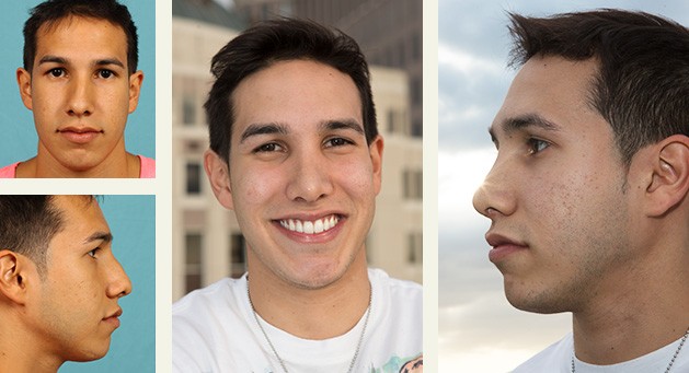 Christian before and after rhinoplasty