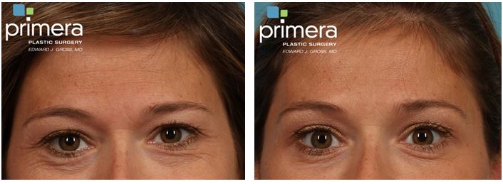 Orlando plastic surgeon shares the 3 places BOTOX works best.