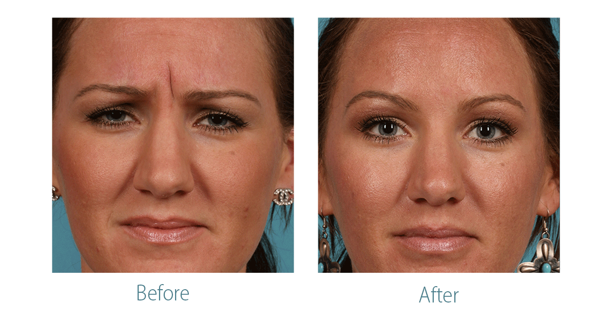 BOTOX Before and After Photo