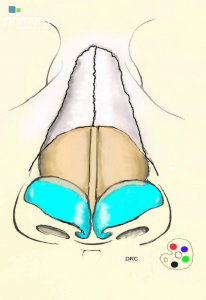 revision rhinoplasty illustration