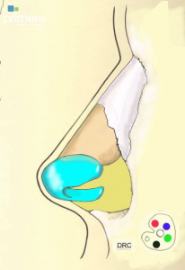 revision rhinoplasty illustration profile view