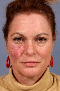 Actual laser skin treatment patient before photo