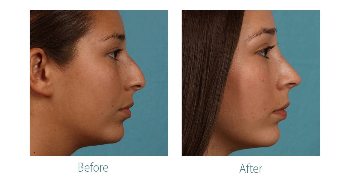 Rhinoplasty Before and After