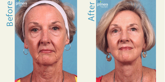 See real patient facelift pictures from Orlando.