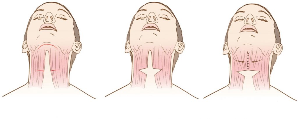 Neck lift procedure diagram