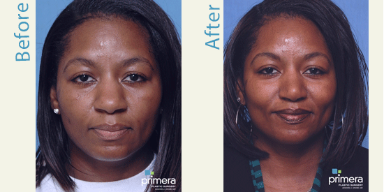 african american rhinoplasty patient before and after front view