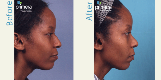 African american rhinoplasty patient before and after photos profile view