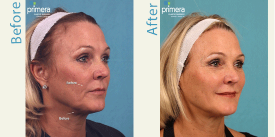 Ultherapy and BOTOX results in Orlando.