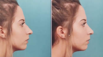 Dr. Gross shares rhinoplasty results at Primera Plastic Surgery in Orlando, FL