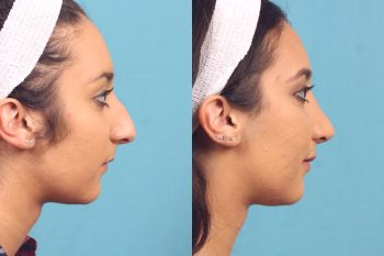 Nose, nose job, Orlando, expert, #1, best, age, Tampa, Gainesville, Ocala, Daytona, Melbourne