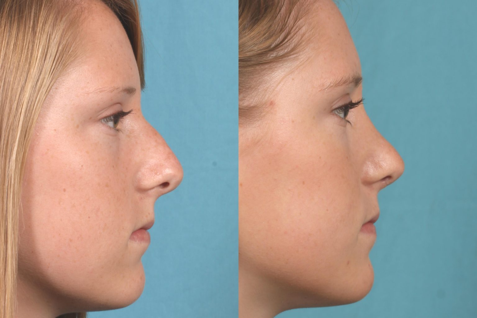 What�s the Best Age for Rhinoplasty? Orlando Surgeon