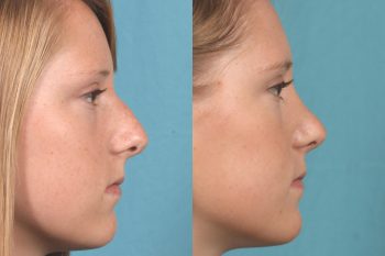 before & after photo Nose job, Rhinoplasty, Orlando, FL, best, #1, expert