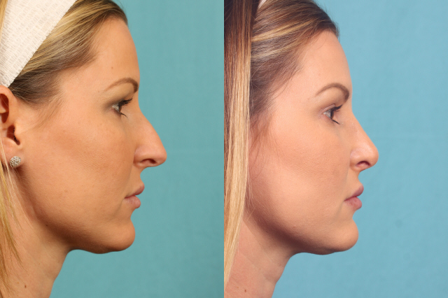 Actual rhinoplasty patient before and after photos profile view