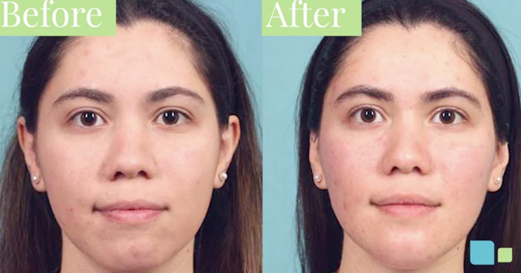 Buccal fat removal before and after photos of actual patient in Orlando