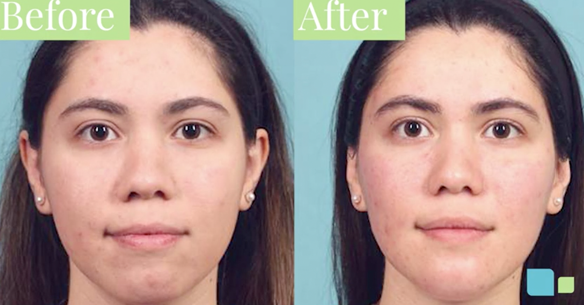 buccal fat removal 10 years later