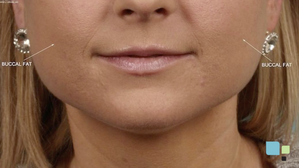 Buccal Fat Removal
