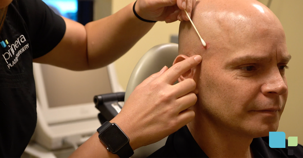 Primera medical staff member preparing male patient for laser mole removal on side of head