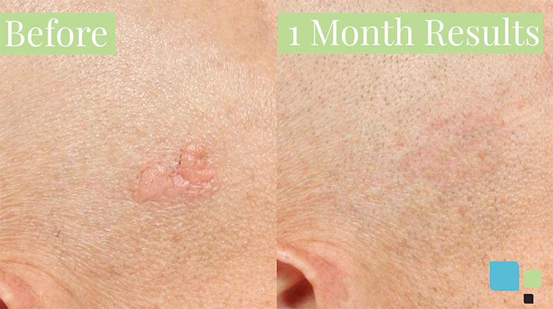 Closeup of mole removal before and after photos