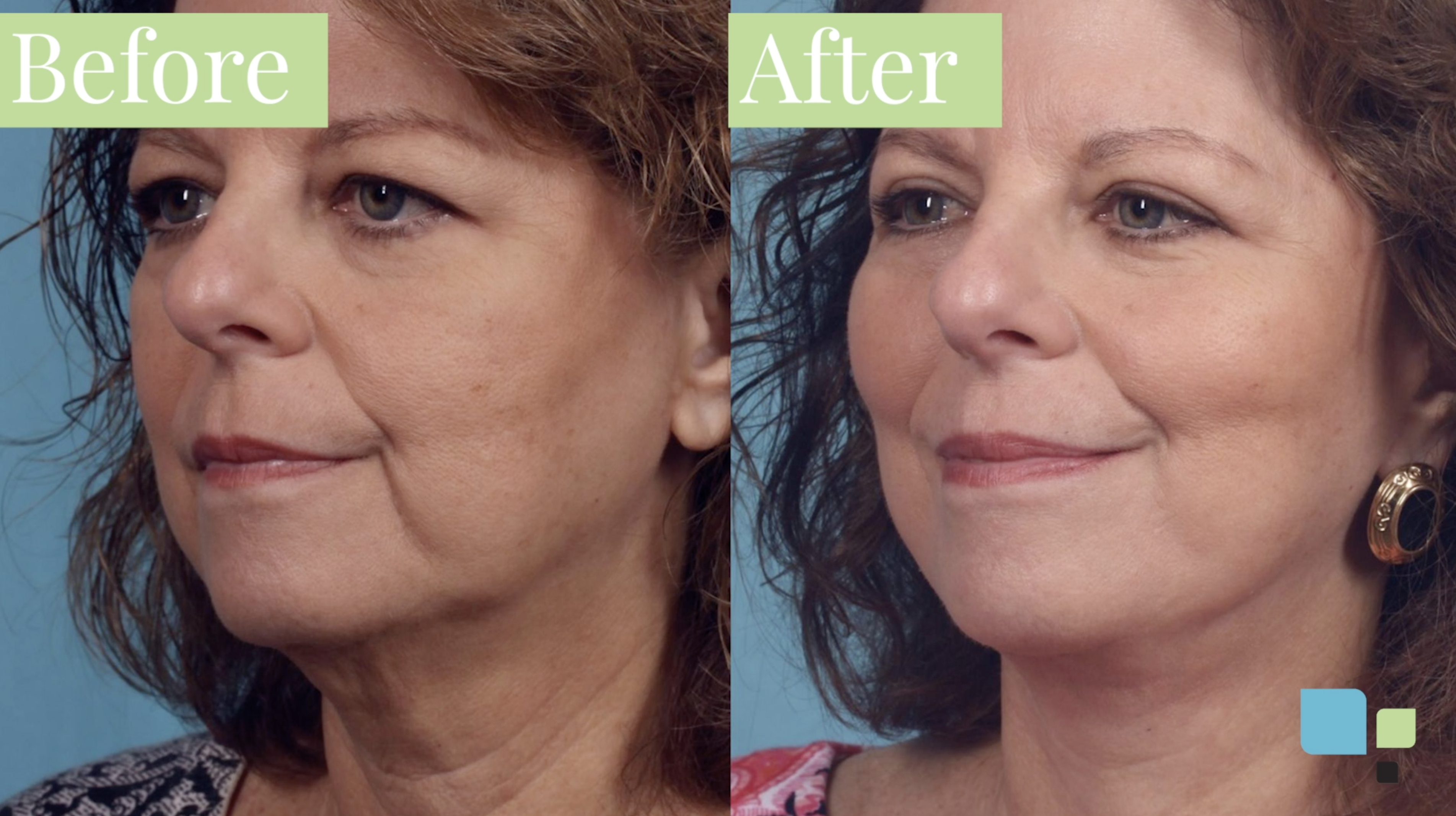 Blepharoplasty before and after photos actual patient