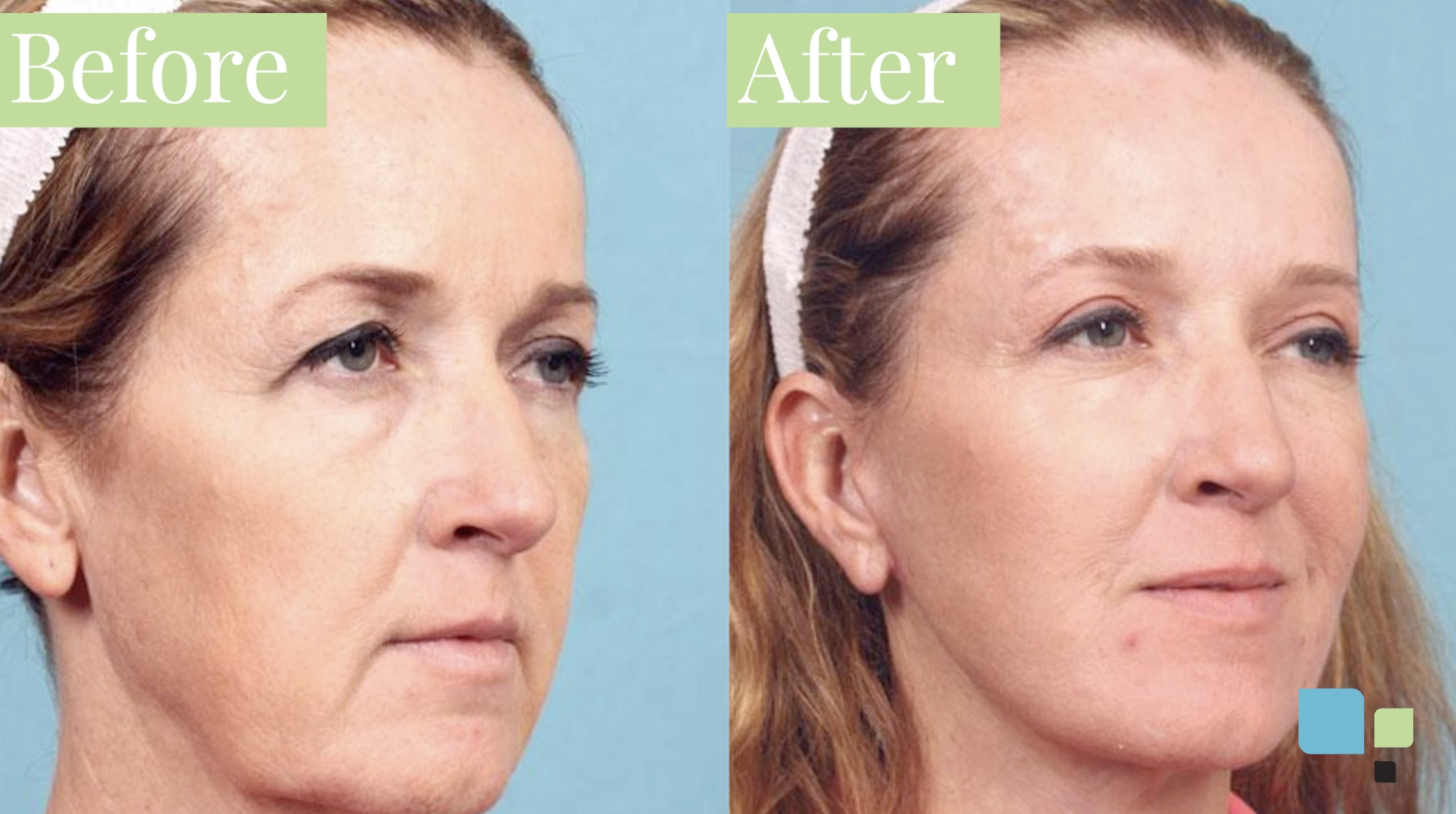 Actual blepharoplasty patient before and after photos