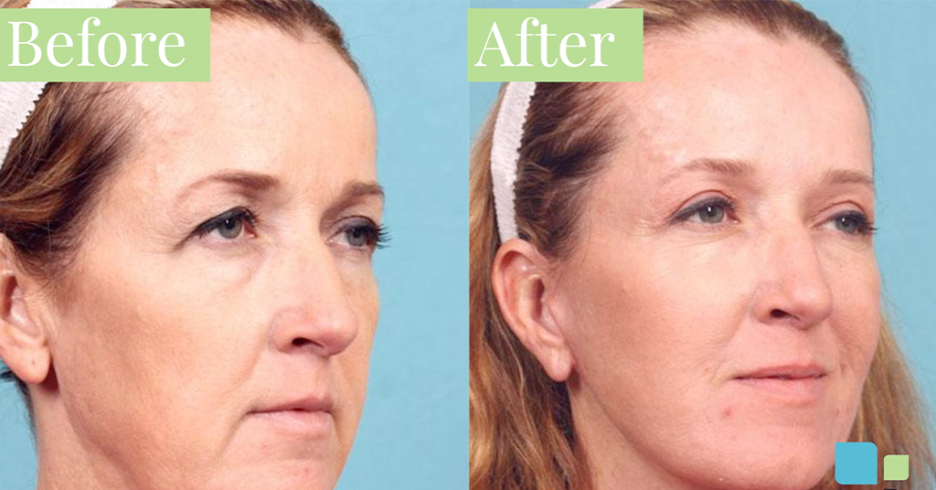 Eyelid surgery before and after photos of woman in Orlando, Florida