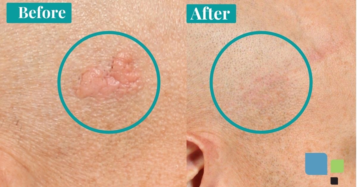 mole removal cream before and after