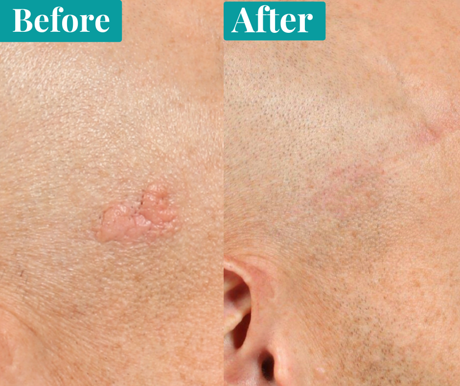 Skin Concerns] Removing mole without scar : r/SkincareAddiction