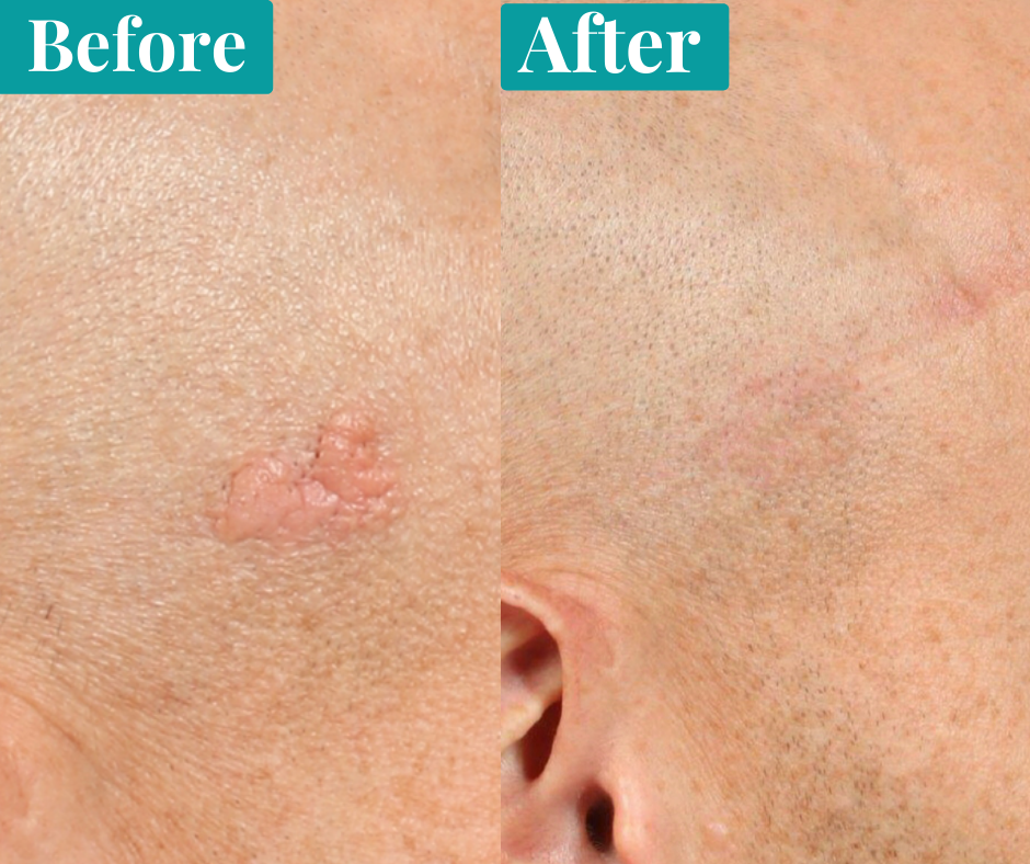 What you need to know about mole removal   Me Clinic