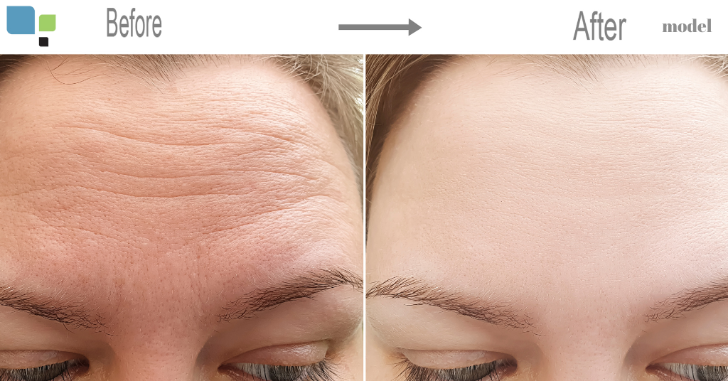 before and after of woman after laser skin treatment (model)