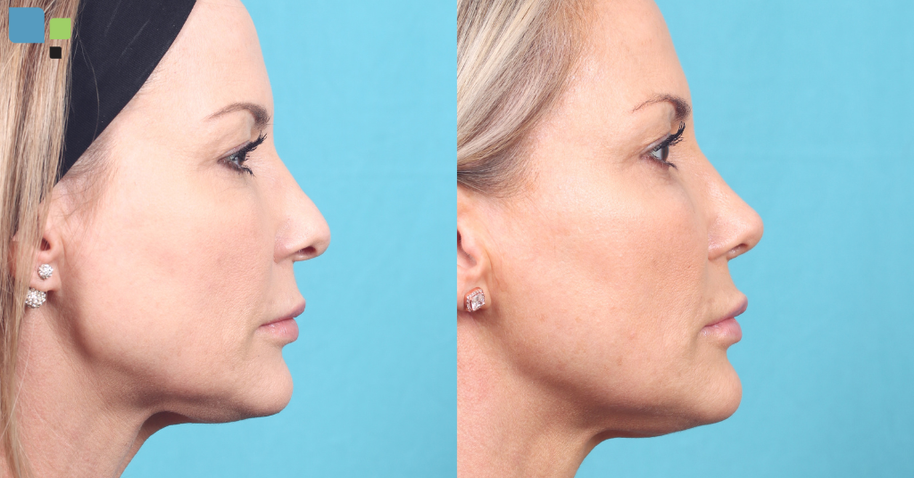 Before and after side profile headshot of a woman who has had Rhinoplasty