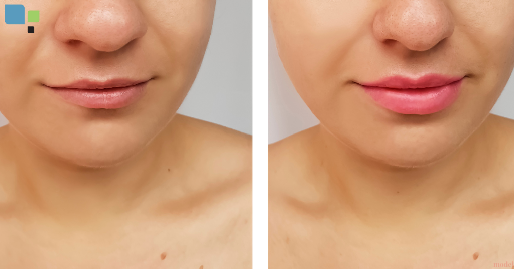before and after of a woman's lip's procedure (model)