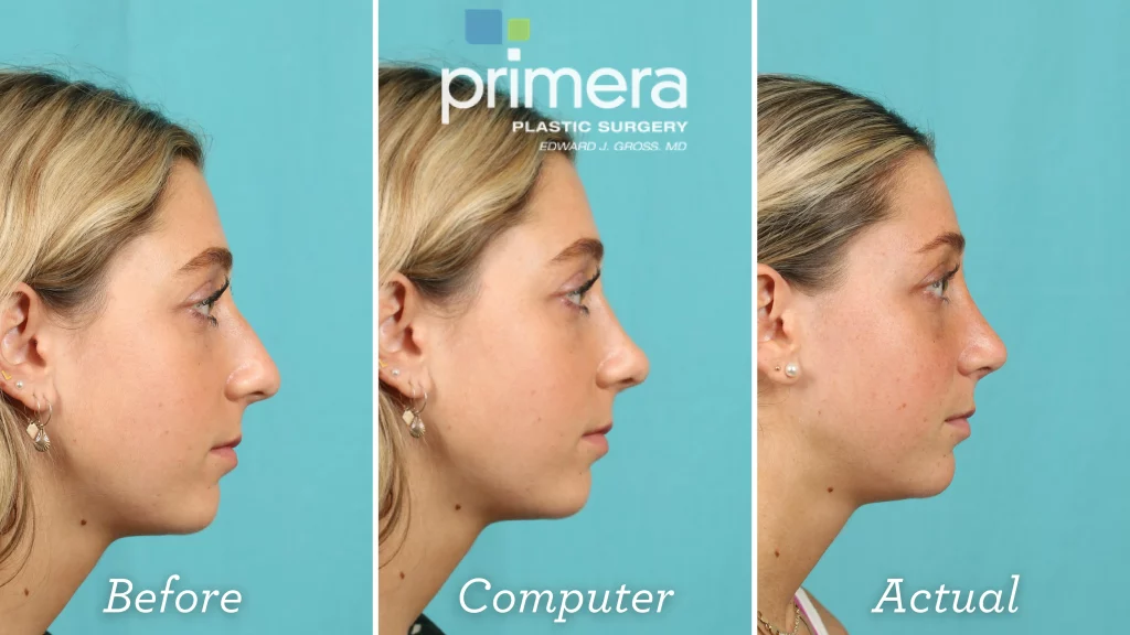 Before, Digitally Computer Imaged, and Actual Resultes for a  rhinoplasty on a young woman