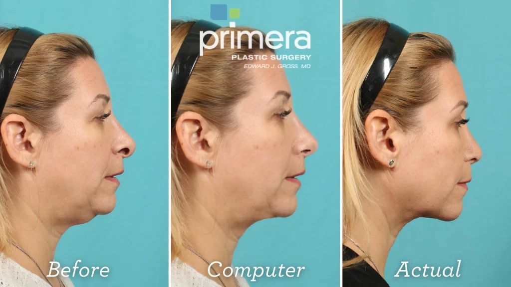 Before, Digitally Imaged, and Actual Resultes for a  rhinoplasty on a woman