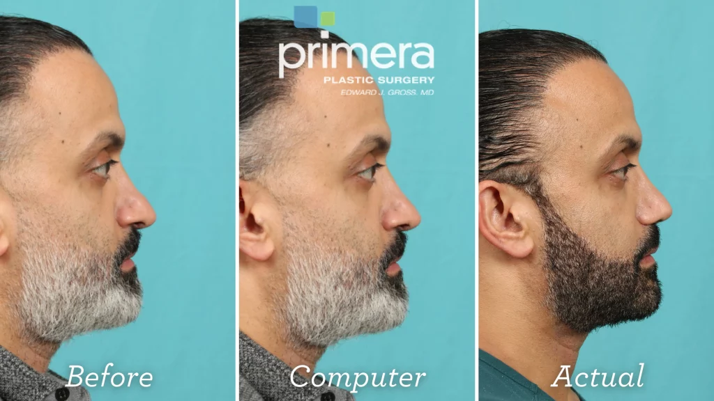 Before, Digitally Computer Imaged, and Actual Resultes for a  rhinoplasty on a man