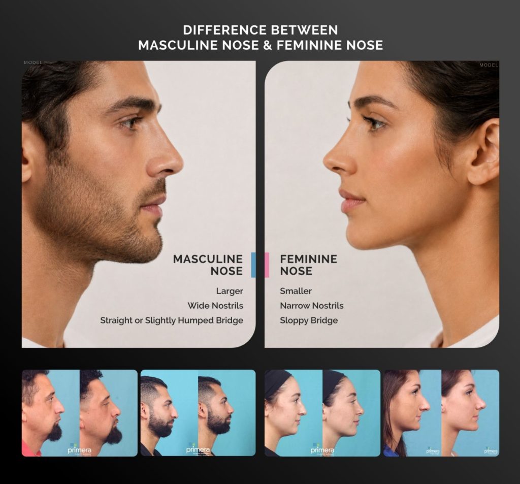Infographic comparing masculine and feminine nose characteristics, with side-profile model illustrations and rhinoplasty before-and-after examples.